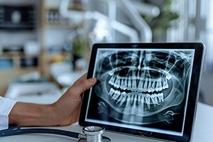 Dentist holding X-ray that shows wisdom teeth