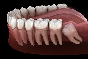 Illustration of impacted wisdom tooth