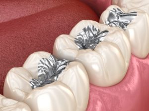 Illustration of teeth that should replace metal fillings